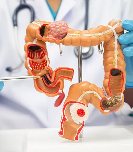 Plan Sindrome Intestino Irritable, Dieta médica, plan personalizado